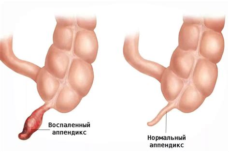 Острый аппендицит: симптомы, диагностика и лечение в Москве — цены и ...