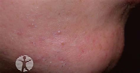 Mild acne image