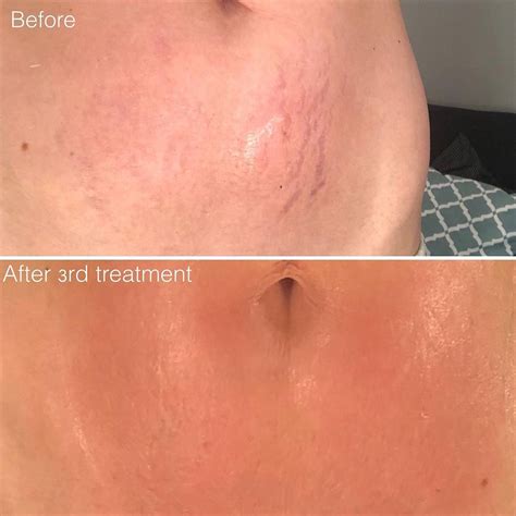 Microneedling Stretch Marks - Does It Work and How?