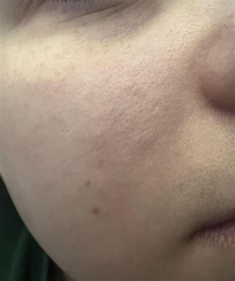 Rash like bumps and texture on inner cheeks that won’t go away? : r