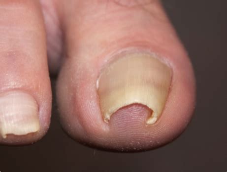 Ingrown Toenails — Mackay Ingrown Toenail Clinic