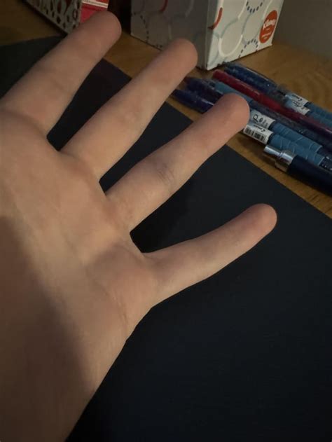 Sprained or Broken ring finger? : r/DiagnoseMe