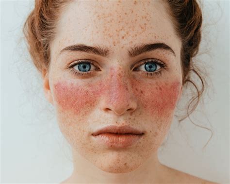 Scientists have finally discovered the cause of lupus