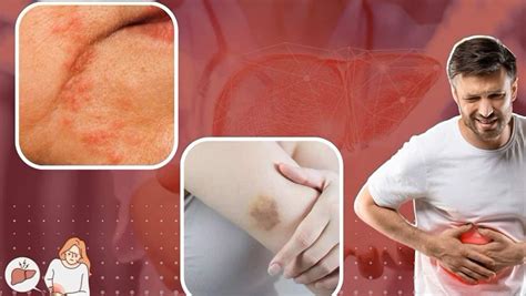 Liver Cirrhosis Symptoms: 9 Warning Skin Signs of Liver Disease You ...