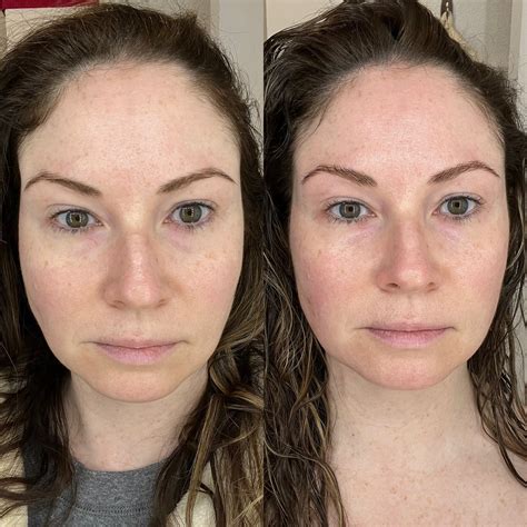 Unbelievable Blackhead Removal 2024: My Honest Review & Before/After Pics. Image 13