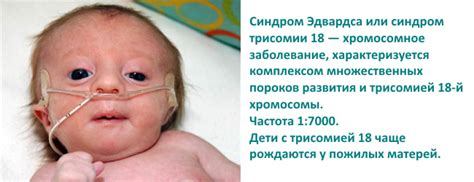 Синдром Эдвардса: причины, симптомы и лечение