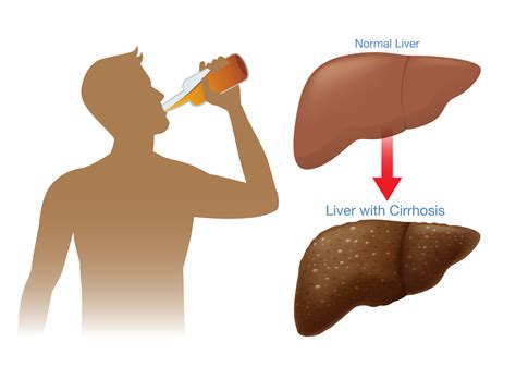 Alcohol Related Liver disease - Early Signs, Treatment and Prevention