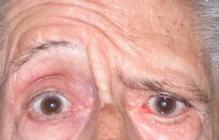 Ptosis de ceja - Dr. Ángel Arteaga Sánchez
