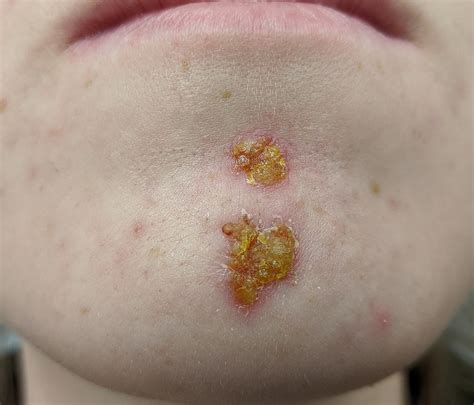 Impetigo | Geeky Medics