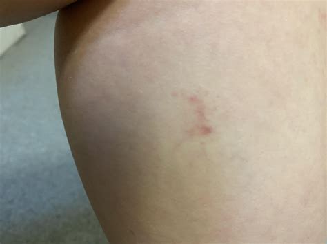 Hickey like rashes on legs (definitely not hickeys) : r