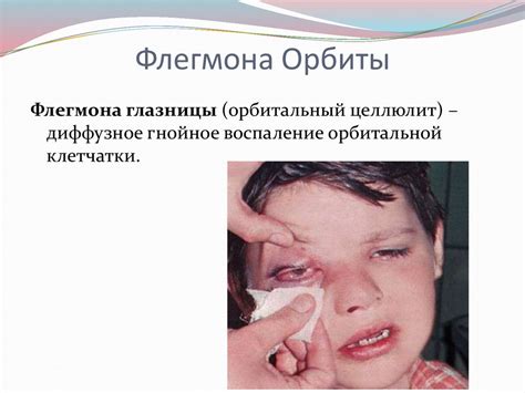 Флегмона орбиты - презентация онлайн