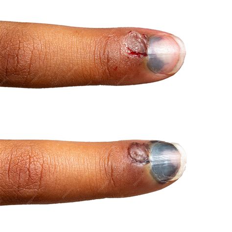 Premium Photo | Evolution after a few days of the hematoma of a crushed