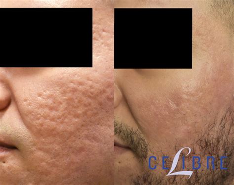Best Acne Scar Treatment