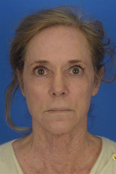 Before and After Laser Skin Resurfacing Photo Gallery | Houston, TX