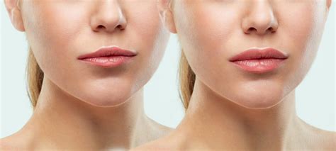 Best Lip Augmentation Surgery | Top 5 Lip Reduction Surgery