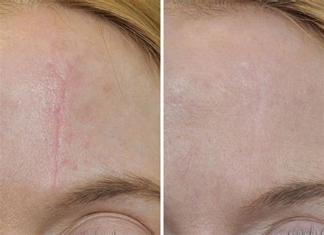 scar removal target adamforillinois