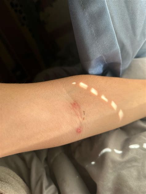 Weird bump on skin : r/DermatologyQuestions