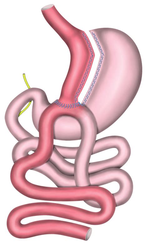 gastricky bypass  jeho role  metabolicke  bariatricke chirurgii