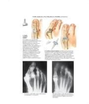 Flexible Implant Resection Arthroplasty for Disabilities of Great Toe