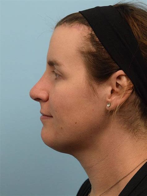 The secret behind what is a v line surgery results today 18