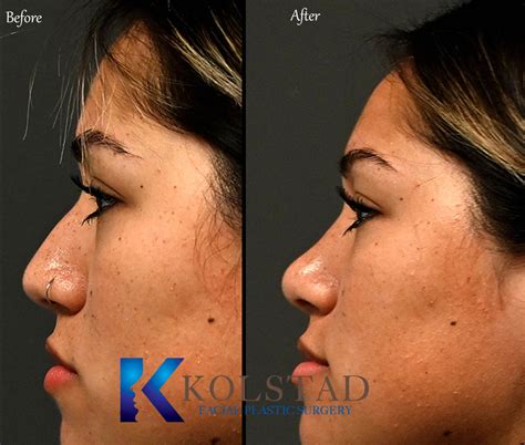 Piezo Rhinoplasty California | Dr. Kolstad - San Diego Facial Plastic Surgeon