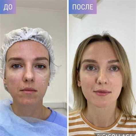 Aesthefill инъекции полимолочной кислотой в Сочи: цена укола Эстефилл в ...