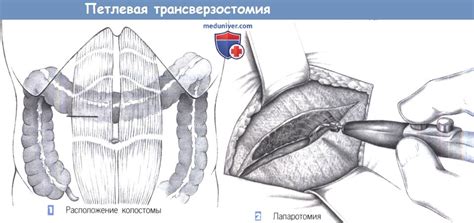 Показания, этапы и техника петлевой трансверзостомии (двуствольной ...