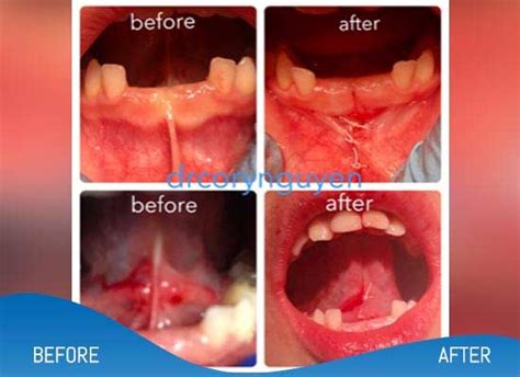 Tongue Tie Surgery Before & After Gallery in Dallas, TX