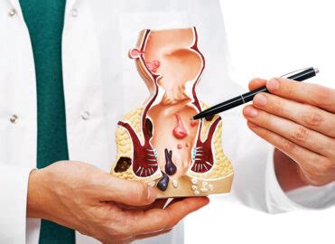 Healing From The Inside Out: The Unseen Route To Taming Internal Hemorrhoids