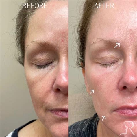 Laser Skin Resurfacing Before & Afters | Roberts Aesthetic & Wellness