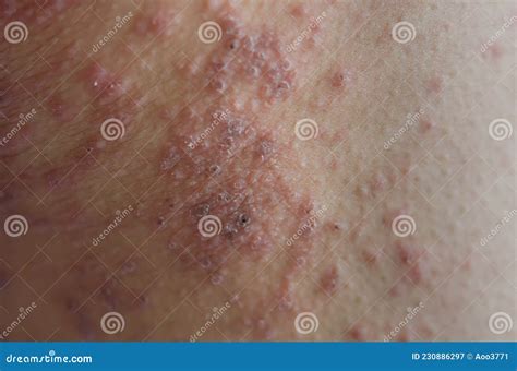 Close-up of Skin Rashes Caused by Allergies Stock Image - Image of boiling, heat: 230886297