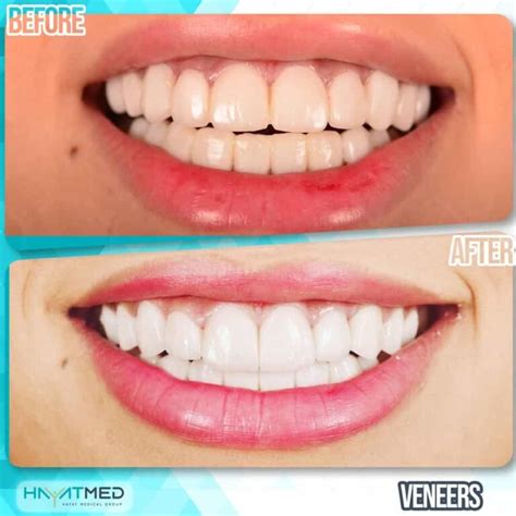 Veneers In Turkey: Is It Worth, And 2022 Packages Price