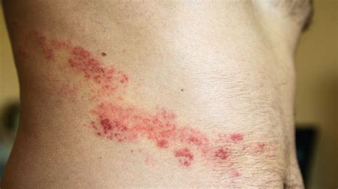 shingles symptoms  treatment