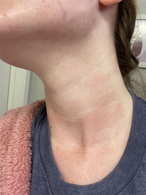Hives only on neck, chest, and face? : r/urticaria