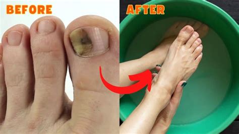 how to treat toenail fungus at home