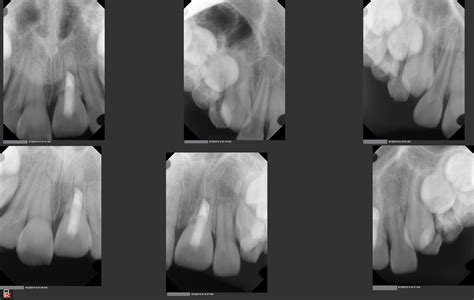 9yo girl, #9 ankylosis and discoloration – TDO University