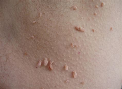 7 types of skin moles and exactly what to do about them - Healthista