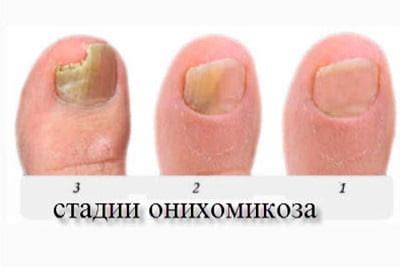 Лечение онихомикоза ногтей: препараты недорогие, но эффективные