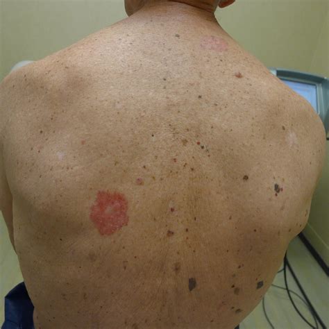 skin cancer symptoms pictures  types signs melanoma