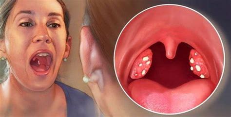 In the mouth in the throat on the glands and tonsils are white purulent ...
