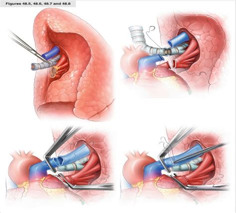 Lung Transplant Surgery, Guidelines, Requirements, Complications