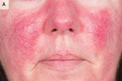 The Four Types of Rosacea – All About it | SL Aesthetic Clinic