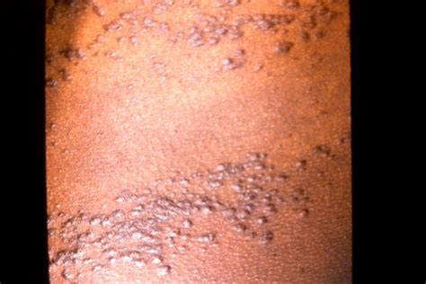 Eruptive Syringoma | Syringoma | Comprehensive Dermatology Photo Atlas ...
