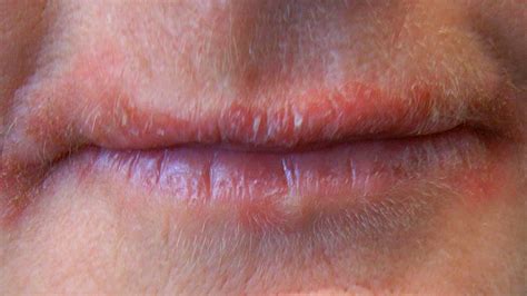 bumps   lip