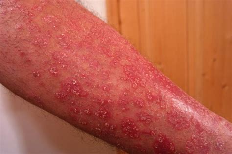 Study: Severe psoriasis may increase risk for type 2 diabetes - UPI.com