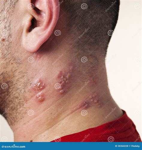 Blisters Caused By Shingles On Skin, Herpes Zoster Stock Photo ...