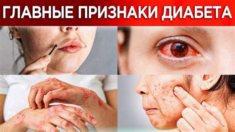 Как понять, что у вас ДИАБЕТ? / Основные признаки диабета, на которые ...