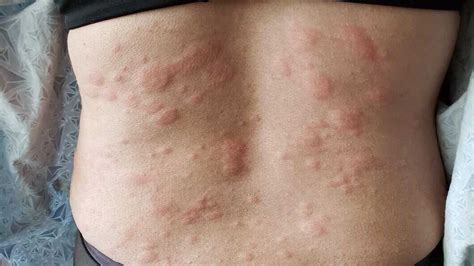 skin disorders symptoms  diagnosis treatment
