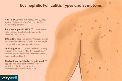 Eosinophilic Folliculitis: Symptoms, Treatment, and More