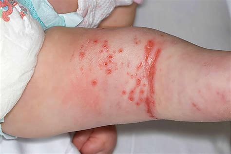Common skin conditions in babies - Mayo Clinic Press